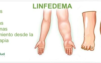LINFEDEMA