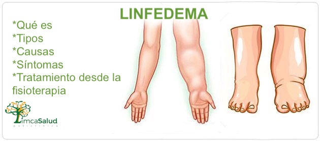 LINFEDEMA